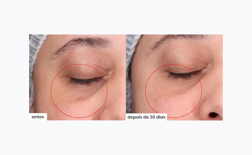 Antes e depois do uso constante do bastão