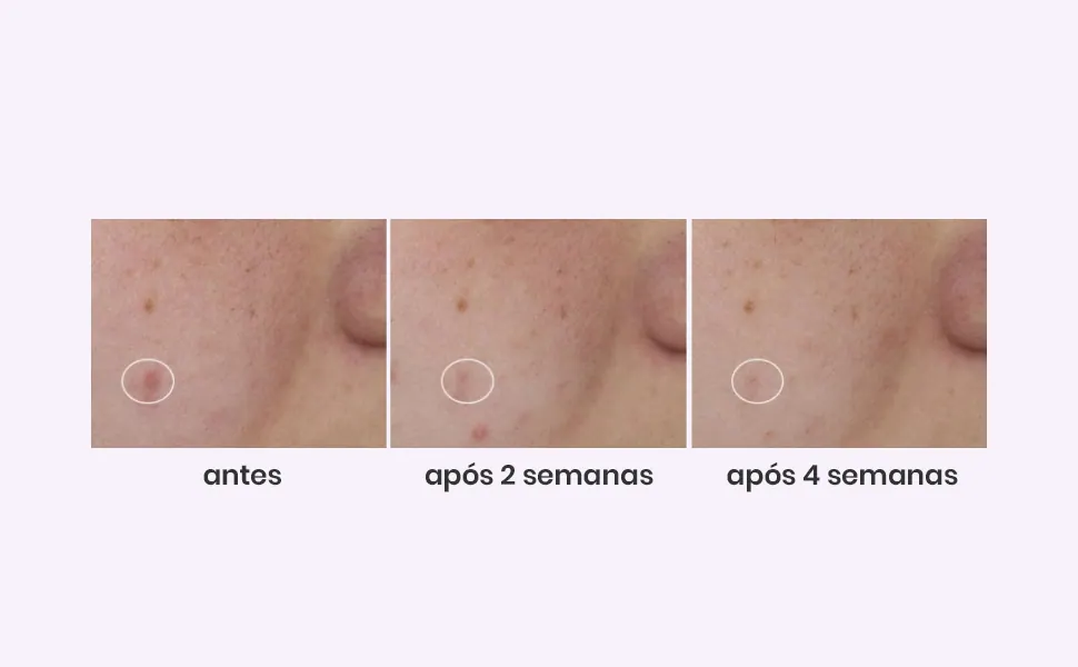 Resultados após 2 e 4 semanas de uso contínuo